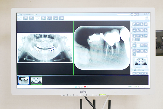 デジタルレントゲン 