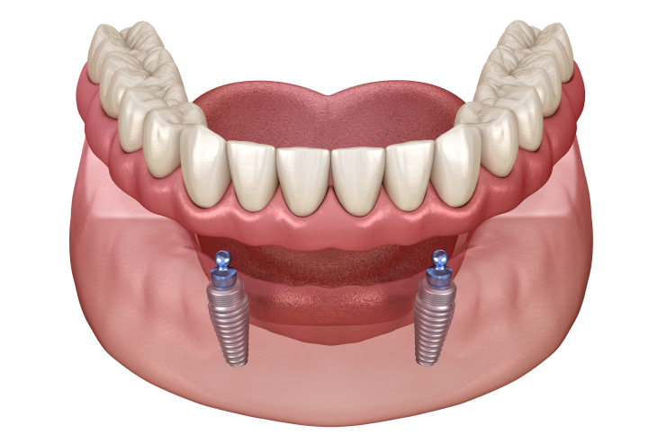 インプラント義歯にも対応
